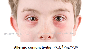 Allergic conjunctivitis کنژنکتیویت آلرژیک