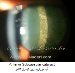آب مروارید زیر کپسول قدامی Anterior Subcapsular cataract