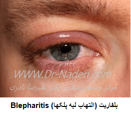 بلفاریت (التهاب لبه پلکها) Blepharitis