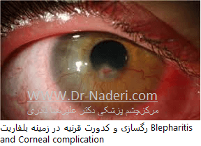 بلفاریت یا التهاب لبه پلک blepharitis or eyelid inflammation