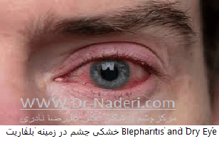 بلفاریت یا التهاب لبه پلک blepharitis or eyelid inflammation