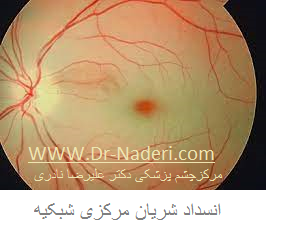 Centeral Retinal Artery Occlosion CRAO انسداد شریان مرکزی شبکیه