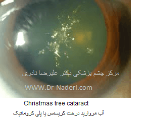 Christmas tree cataract آب مروارید درخت کریسمس یا پلی کروماتیک 