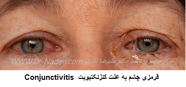 قرمزی چشم به علت کنژنکتیویت Conjunctivitis