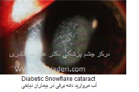 Diabetic Snowflake cataract آب مروارید دانه برفی در بیماران دیابتی 