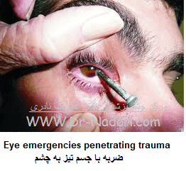  Eye emergencies penetrating traumaضربه با جسم تیز به چشم