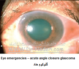  Eye emergencies - acute angle closure glaucomaگلوکوم حاد