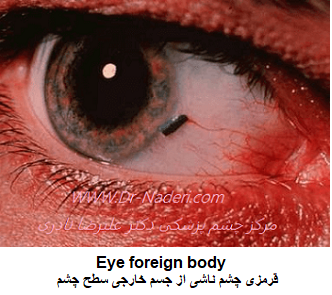  Eye foreign body قرمزی چشم ناشی از جسم خارجی سطح چشم