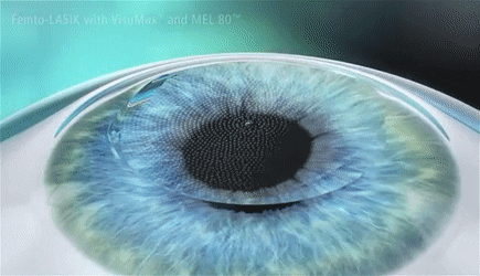 Femto LASIK Eye surgery جراحی فمتولیزیک چشم