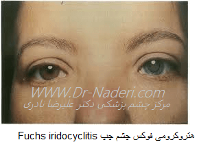 Fuchs hetrochromic iridocyclitis هترو کرومی فوکس (رنگ متفاوت دو چشم)
