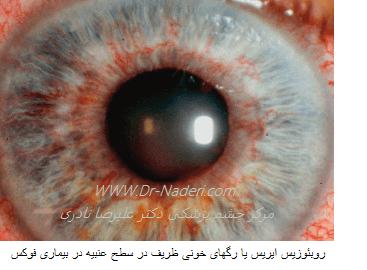 Iris Rubeosis روبئوزیس عنبیه در بیماری فوکس