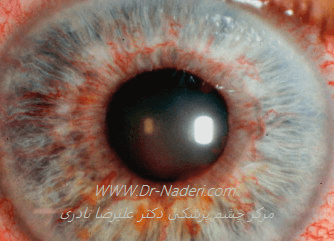 روبئوزیس عنبیه در بیماری فوکس Fuchs iridocyclitis