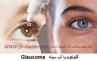 glaucoma اب سیاه