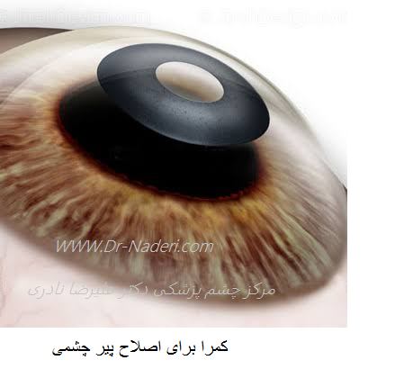  Kamera corneal inlayکمرا برای اصلاح پیر چشمی 