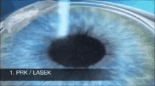 LASEK eye surgery جراحی لازک چشم