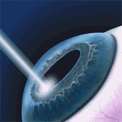 laser refractive surgery جراحی لیزری اصلاح عیب انکساری
