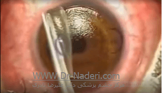 What Is LASEK Eye Surgery