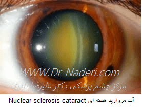 آب مروارید هسته ای Nuclear sclerosis cataract