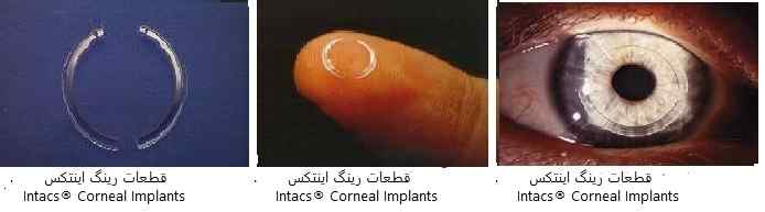 Intacs® Corneal Implants قطعات رینگ اینتکس 