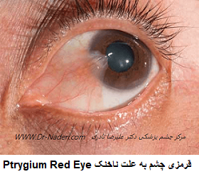 قرمزی چشم به علت ناخنک Ptrygium Red Eye