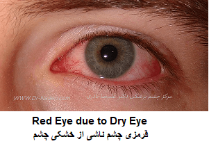 قرمزی چشم ناشی از خشکی چشم