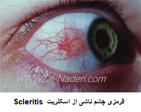 Scleritis قرمزی چشم ناشی از اسکلریت 