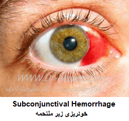 خونریزی زیر ملتحمه Subconjunctival Hemorrhage