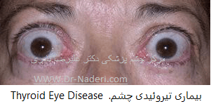 تیروئید  و  چشم thyroid eye disease