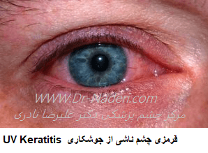  UV Keratitis  قرمزی چشم ناشی از جوشکاری
