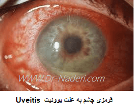  Uveitis  قرمزی چشم به علت یووئیت