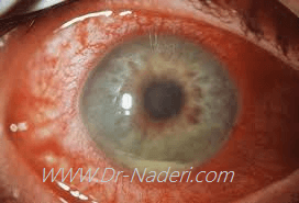 التهاب داخل چشم - یووئیت Uveitis
