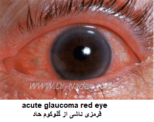 قرمزی ناشی از گلوکوم حاد acute glaucoma red eye