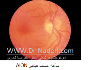 Anterior ischemic optic neuropathy (AION) سکته عصب چشم 