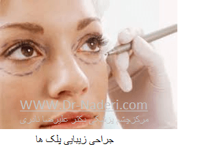 blepharoplasty بلفاروپلاستی یا جراحی زیبایی پلک 