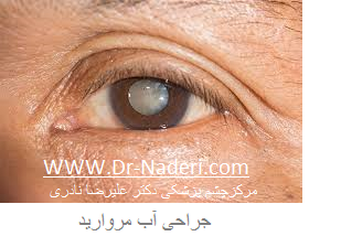 cataract surgery جراحی آب مروارید یا کاتاراکت