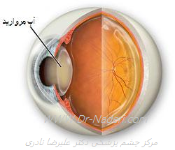 آب مروارید یا کاتاراکت cataract 