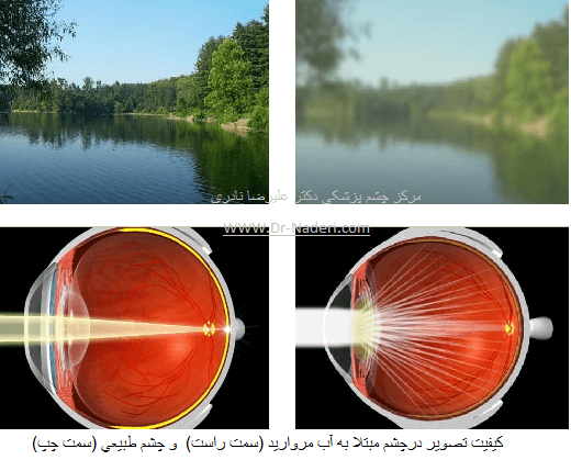 علائم آب مروارید cataract symptom
