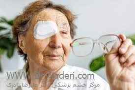 محدودیت-فعالیت بعد از عمل آب مروارید Activities Should Be Avoided After Cataract Surgery