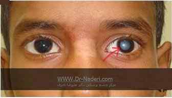 درمان آّب مروارید بدون جراحی Can Cataracts Be Treated Without Surgery