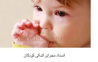 children tear duct obstruction انسداد مجرای اشکی کودکان
