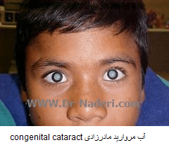 آب مروارید مادرزادی congenital cataract 1آ