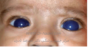 آب سیاه گلوکوم مادرزادی congenital glaucoma