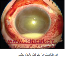 endophthalmitis اندوفتالمیت یا عفونت داخل چشم