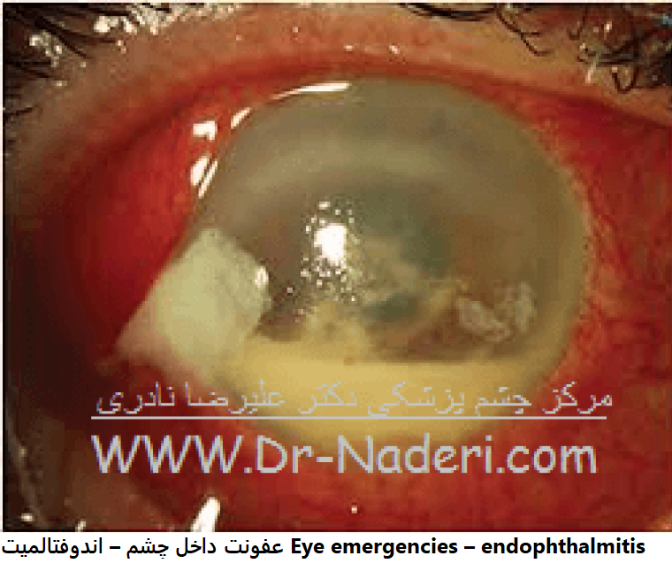 اندوفتالمیت یا عقونت چشم Endophthalmitis