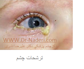 eye discharge ترشحات چشم