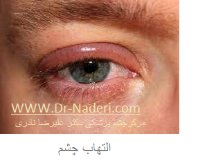 eye inflammation التهاب چشم