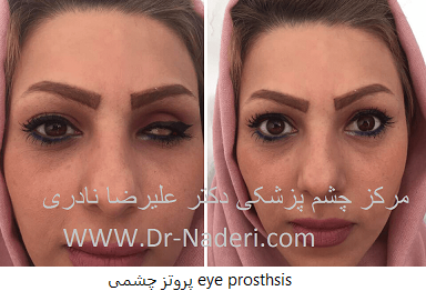 پروتز چشمی eye prosthsis