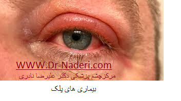 eyelid disease بیماری های پلک