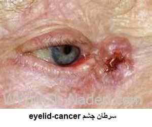 سرطان چشم