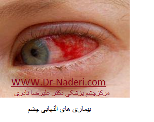 inflammatory eye disease بیماری های التهابی چشم